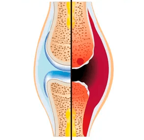 Der Aufbau eines gesunden und abgenutzten Gelenks mit der Bezeichnung Knorpelgewebe und Gelenkflüssigkeit